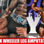 Flex Wheeler，緊急手術で右脚を切断